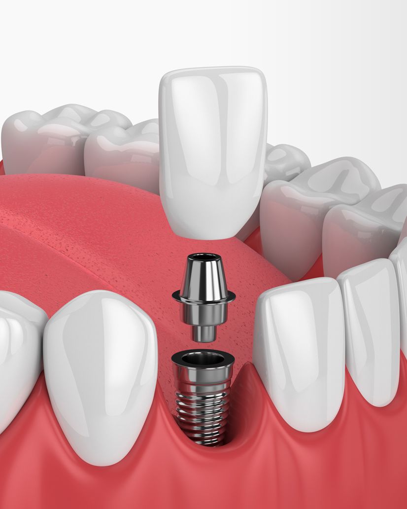 インプラント治療